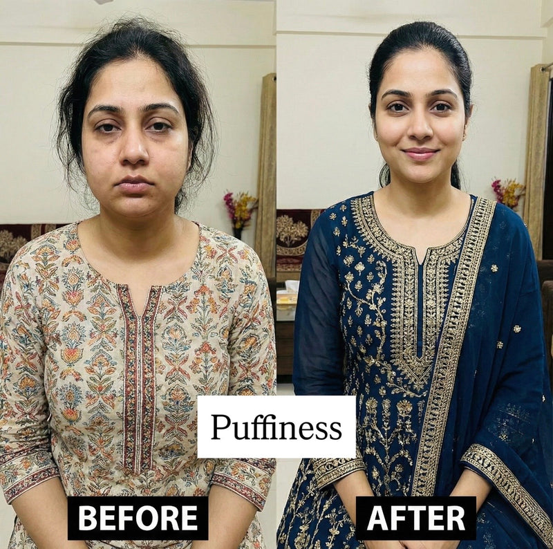 Reduced under-eye circles in 5 weeks — Anjali, 31